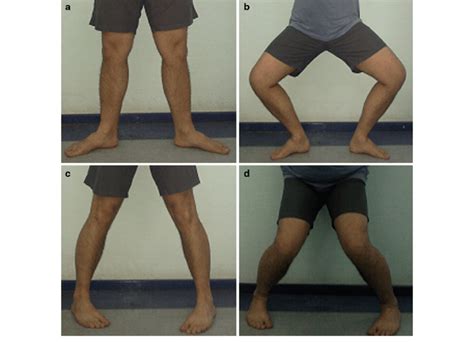 squat test for meniscus tear